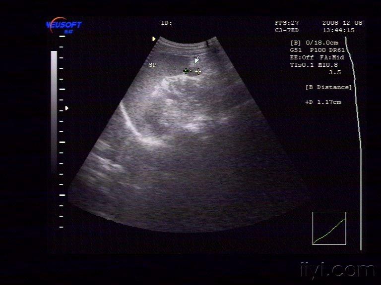 副脾- 超声医学讨论版 - 爱爱医医学论坛