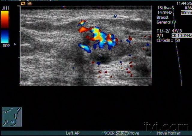 两例乳腺导管扩张伴实性占位声像图 - 超声医学讨论版