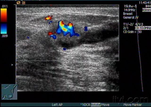 两例乳腺导管扩张伴实性占位声像图 - 超声医学讨论版