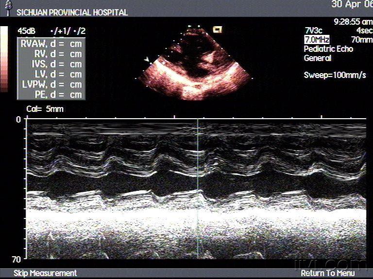 完全性心内膜垫缺损超声图谱