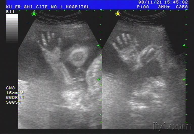 【贴图】胎儿的手