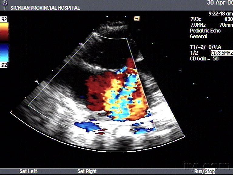 完全性心内膜垫缺损超声图谱