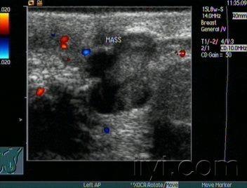 两例乳腺导管扩张伴实性占位声像图 - 超声医学讨论版