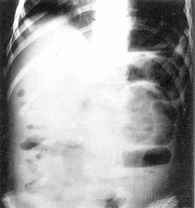 【会诊】各位专家见过这样的腹部x线片吗