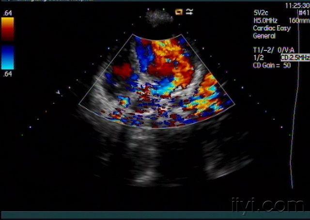 右侧冠状动脉左室瘘 超声医学讨论版 爱爱医医学论坛