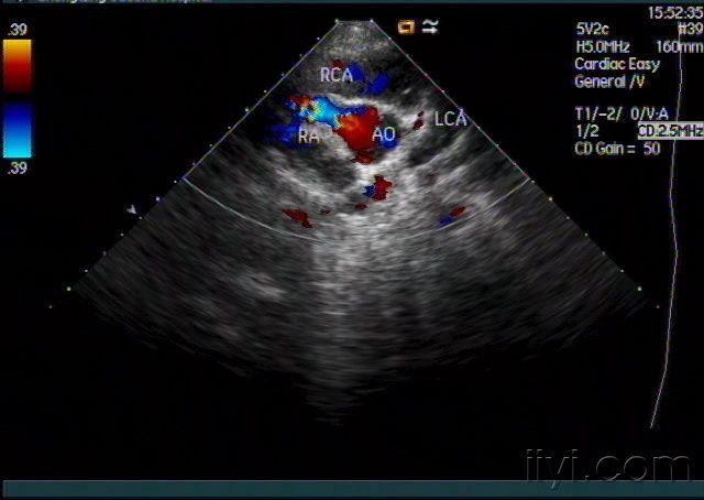右侧冠状动脉左室瘘 超声医学讨论版 爱爱医医学论坛