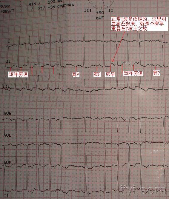 请各位老师发表一下高见 心电图脑电图专业讨论版 爱爱医医学论坛