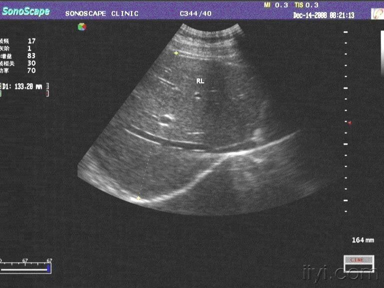 肝左叶形态不规则稍强回声 - 超声医学讨论版 - 爱爱