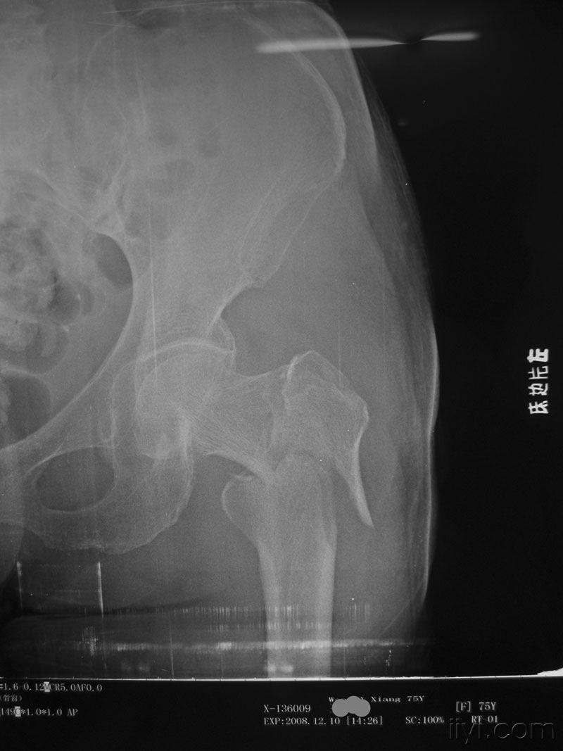 老年性股骨反粗隆合并股骨颈基底部骨折
