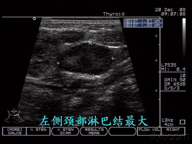 腮腺炎(淋巴性 超声医学讨论版 爱爱医医学论坛