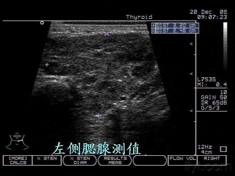 腮腺炎(淋巴性) - 超声医学讨论版 - 爱爱医医学论坛