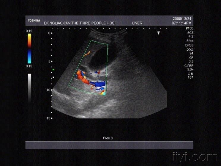 胆总管结石 - 超声医学讨论版 - 爱爱医医学论坛