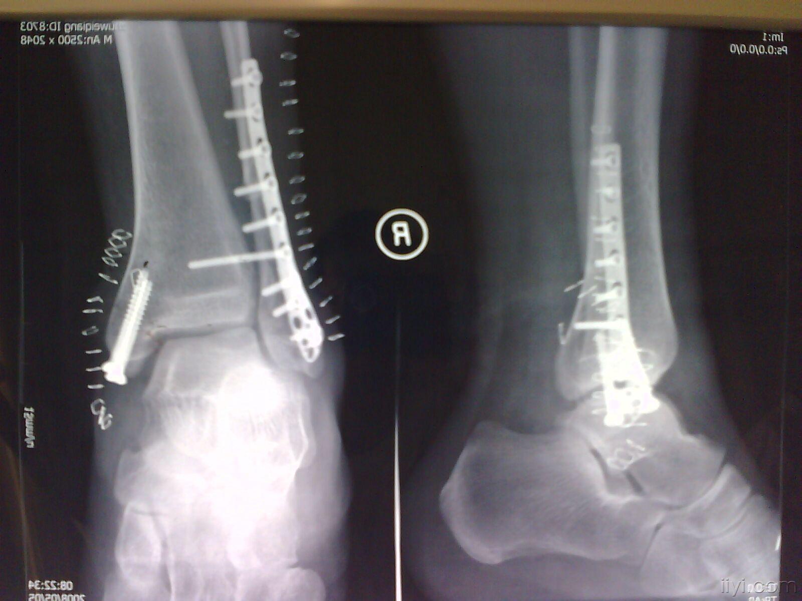 踝关节骨折脱位 的分型(术前术后对比)