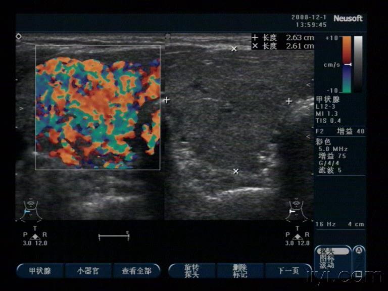 是结节性甲状腺肿吗? - 超声医学讨论版 - 爱爱医医学