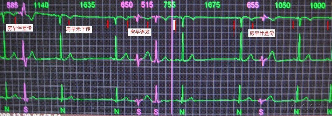 电图专业讨论版 69 心律失常除第三幅图中间一个考虑室早室性融合波