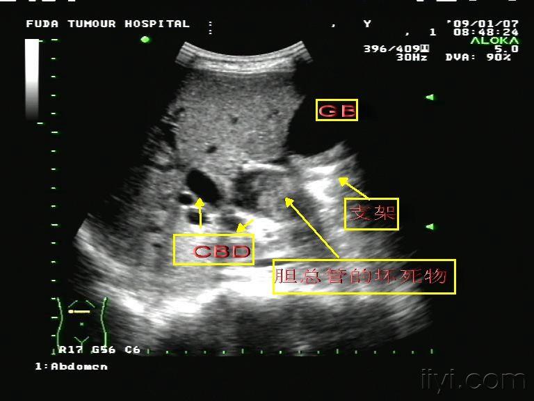 胰腺癌 - 超声医学讨论版 - 爱爱医医学论坛