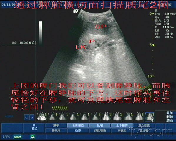 胰腺超声扫描探讨与相关病例应用