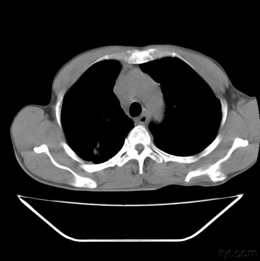 肺癌ct片!