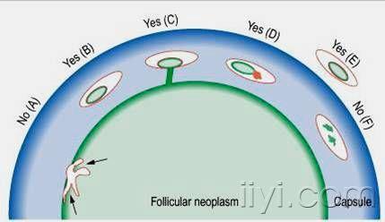 ssp16滤泡性甲状腺癌的血管和包膜浸润