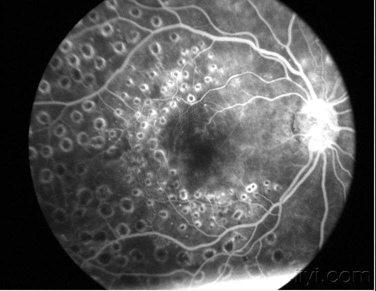 眼底造影图片