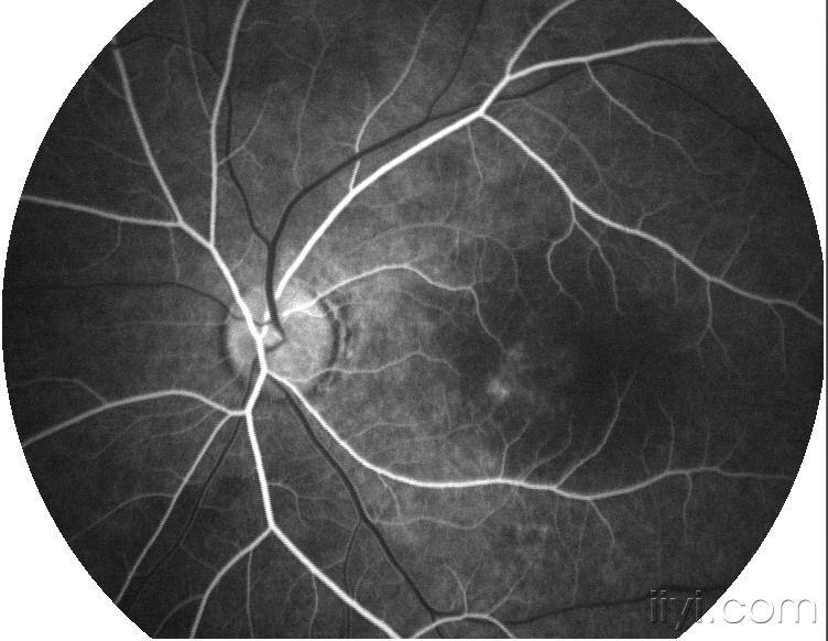 眼底造影图片