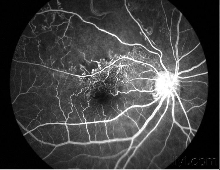 糖尿病视网膜眼底(无灌注区,新生血管.jpg