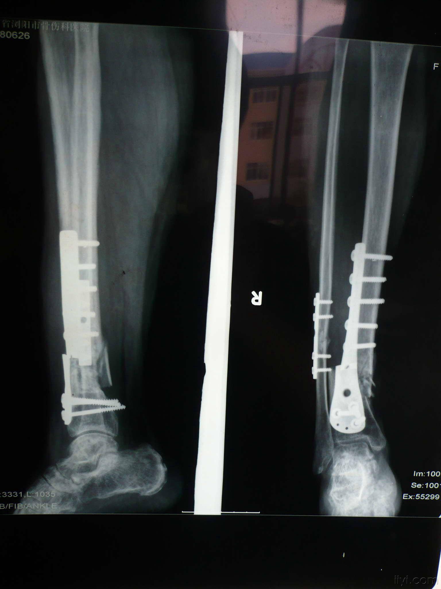 胫骨骨折术后5个月未见明显骨痂