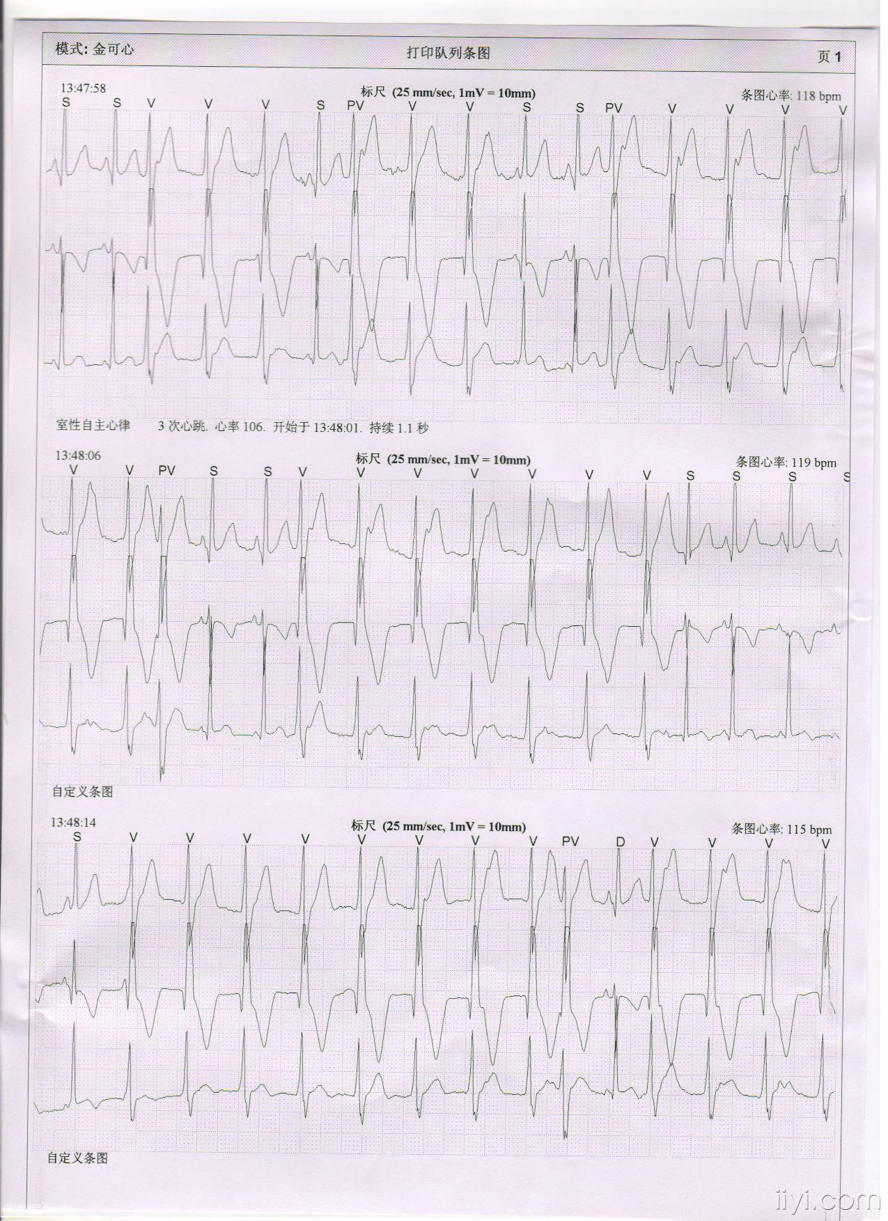 急求助一份心律失常心电图