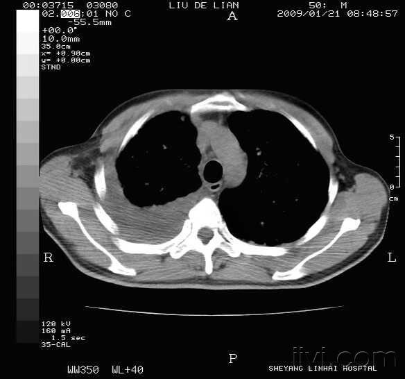 肺癌纵隔淋巴结,两肺及胸膜转移!