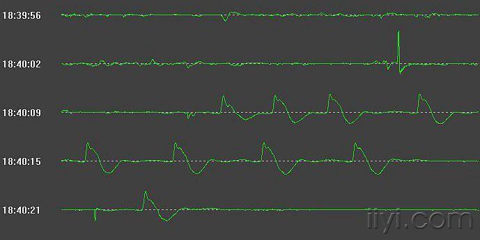 死亡之旅监护心电图分析