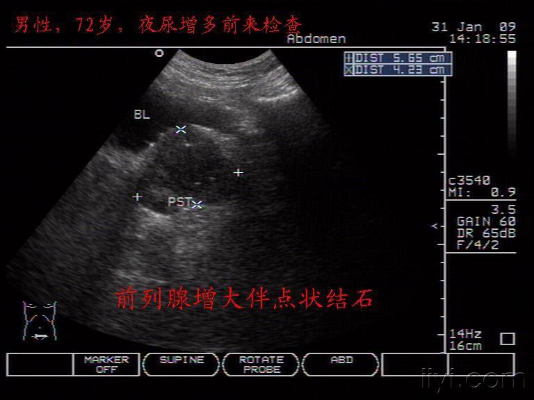 前列腺