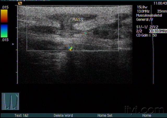 双侧臀部皮下脓肿声像图. - 超声医学讨论版 - 爱爱医