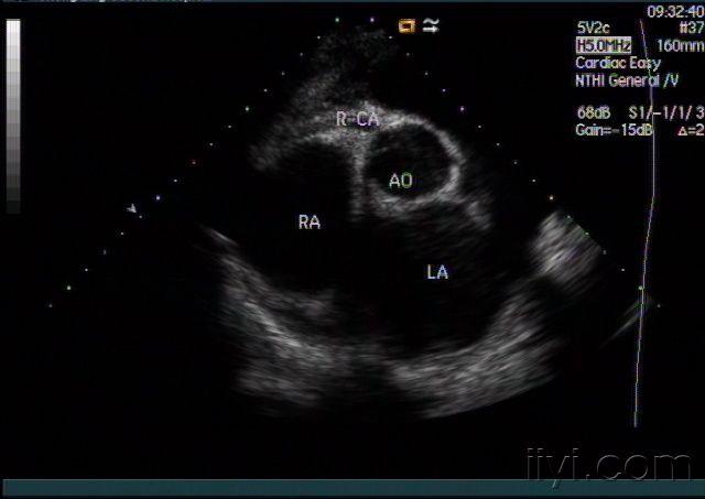 右冠状动脉声像图 - 超声医学资源版 - 爱爱医医学论坛
