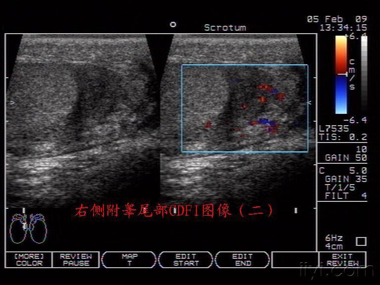 急性附睾炎 - 超声医学讨论版 - 爱爱医医学论坛