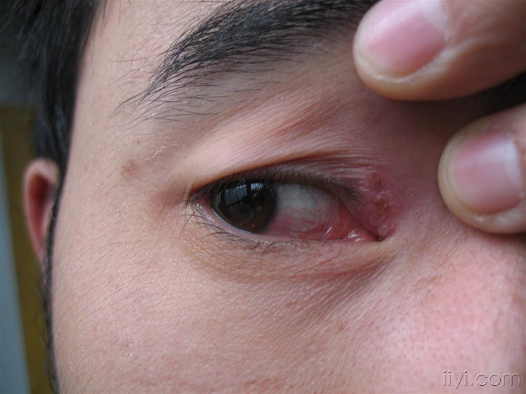 右眼肿了 以前看医生说的是眼角内结膜炎。_百度知道