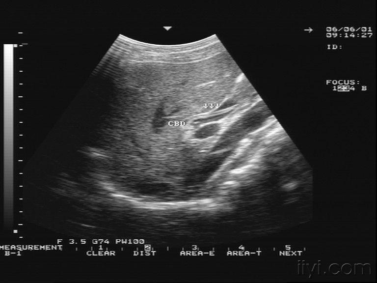 胆道蛔虫 - 超声医学讨论版 - 爱爱医医学论坛