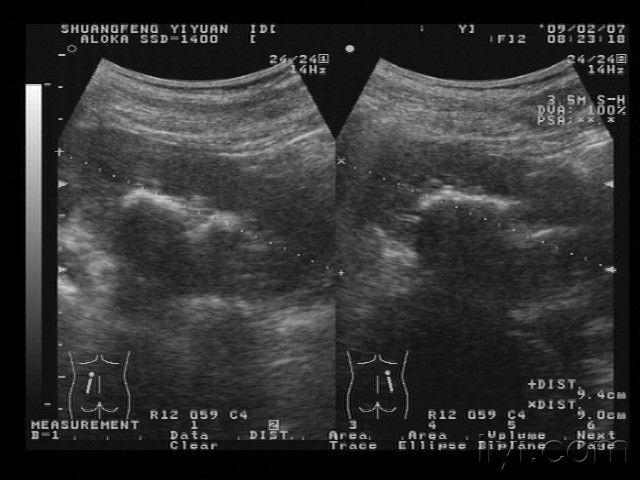 双肾结石(供初学者)