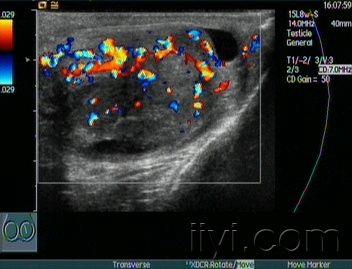 手术证实右侧附睾单纯性囊肿 - 超声医学讨论版 - 医