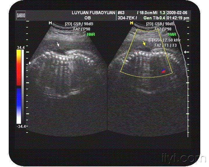 再发一例胎儿畸形(脊柱裂伴脊膜膨出,脑积水 超声医学讨论版