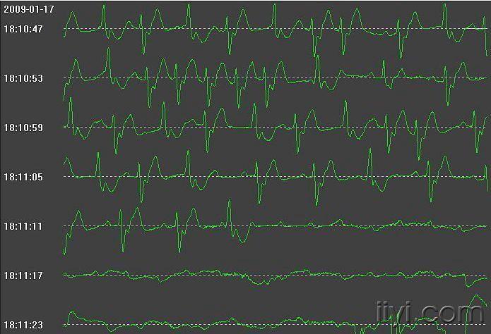 求:心电机械分离 和心室静止 的心电图图形