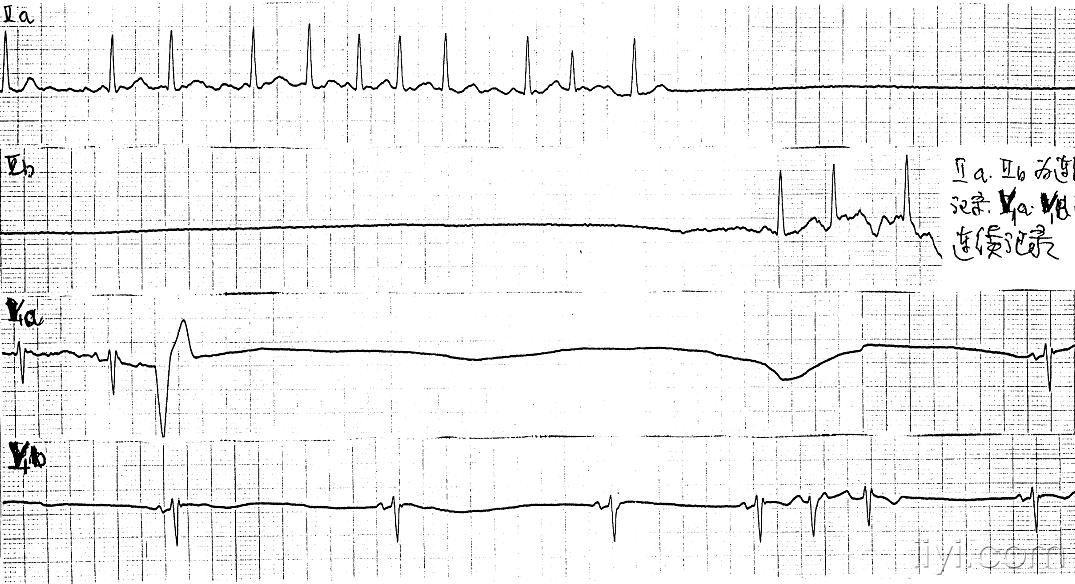 求:心电机械分离 和心室静止 的心电图图形