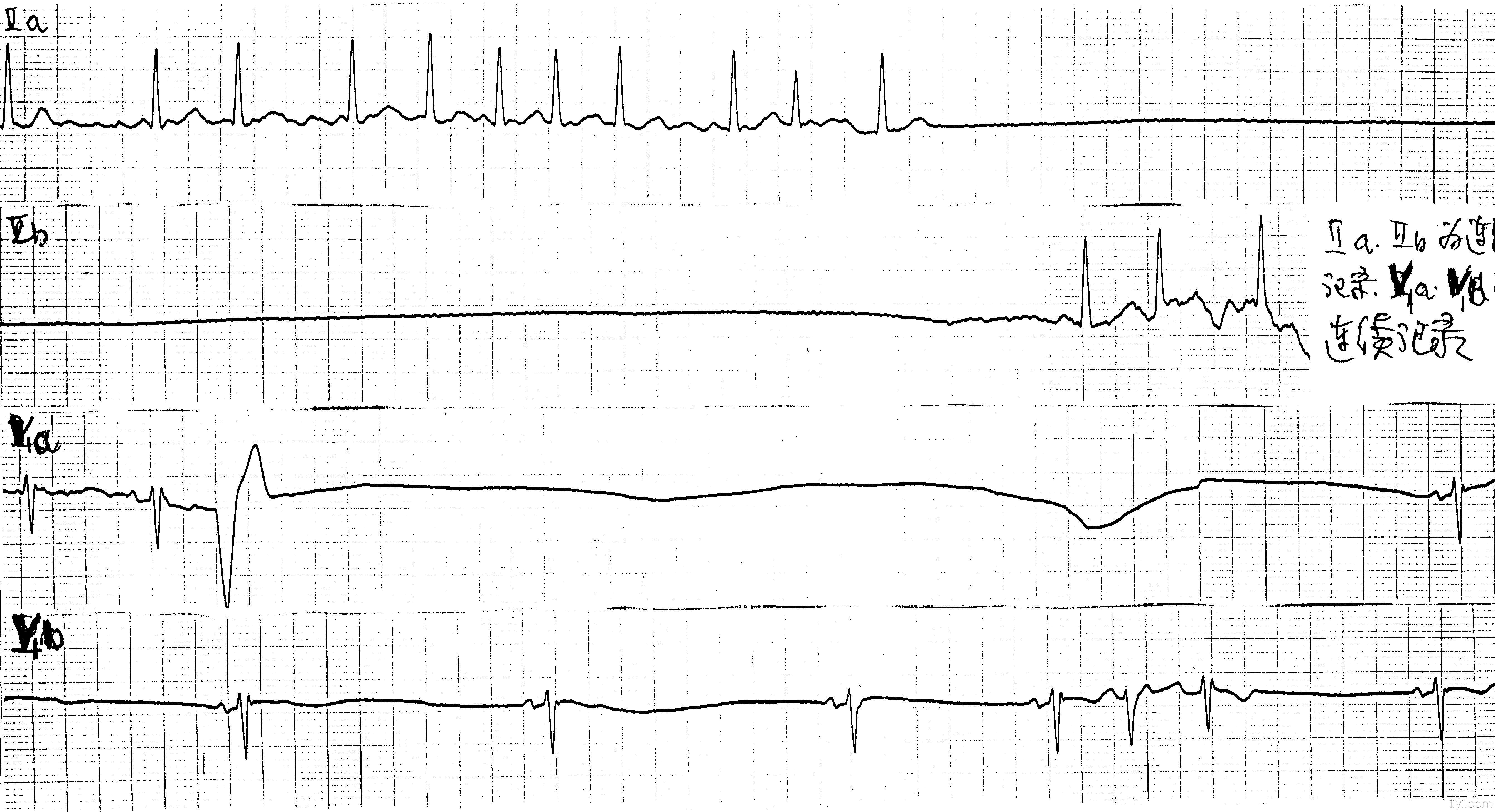 求:心电机械分离 和心室静止 的心电图图形
