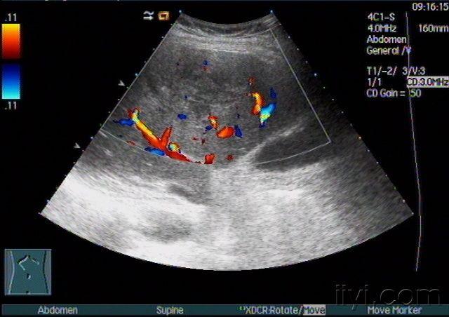 补上一周以前的声像图片,超声提示早期肝脓肿可能,建议进一步检查