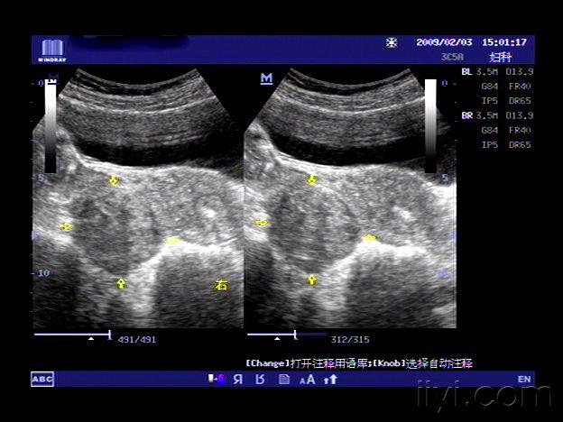 浆膜下子宫肌瘤 超声医学讨论版 爱爱医医学论坛