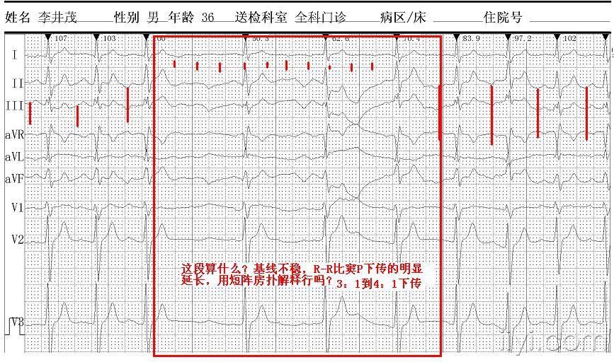 求助36岁男性患者心电图诊断是短阵房速么