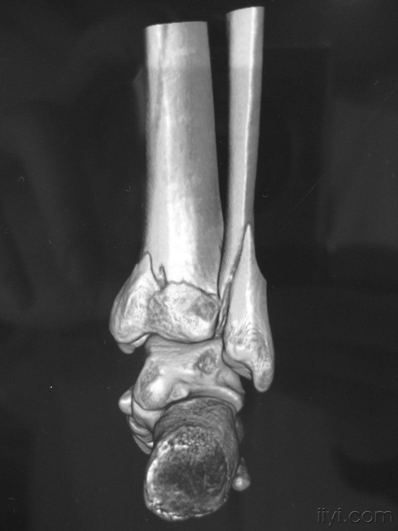 旋后外旋Ⅳ度踝部骨折一例
