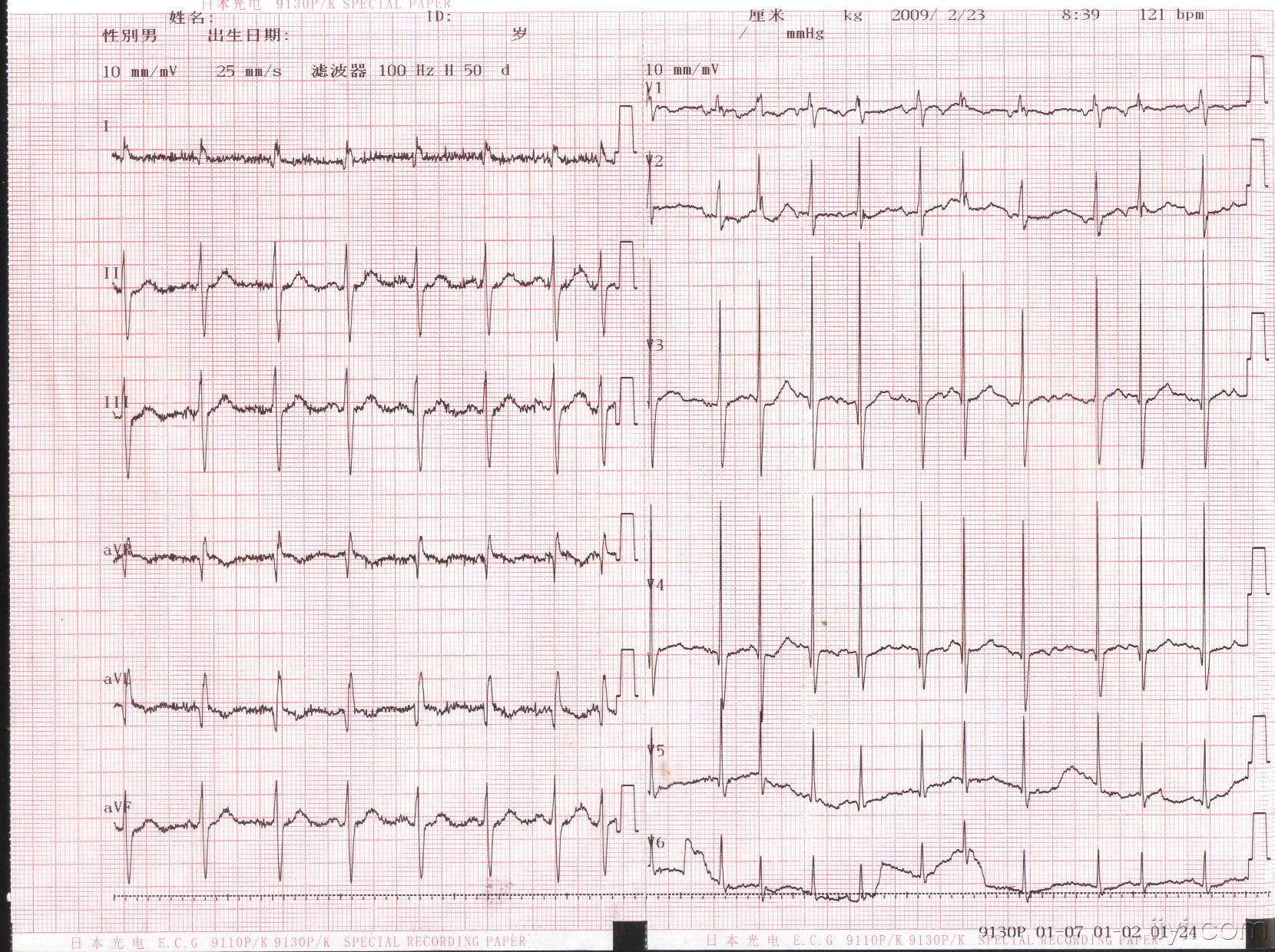 求助复杂心电图2份