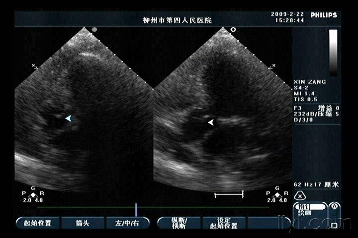 主动脉瓣脱垂? - 超声医学讨论版 - 爱爱医医学论坛