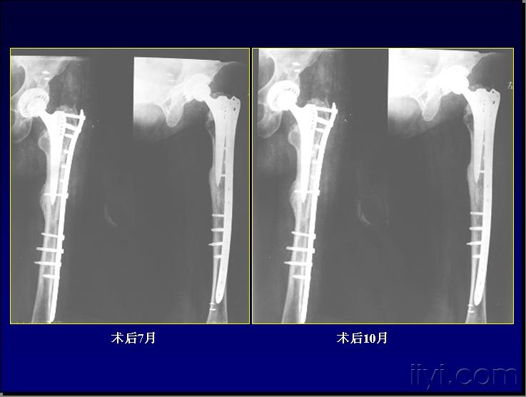 人工股骨头置换术后一年余骨折如何处置?