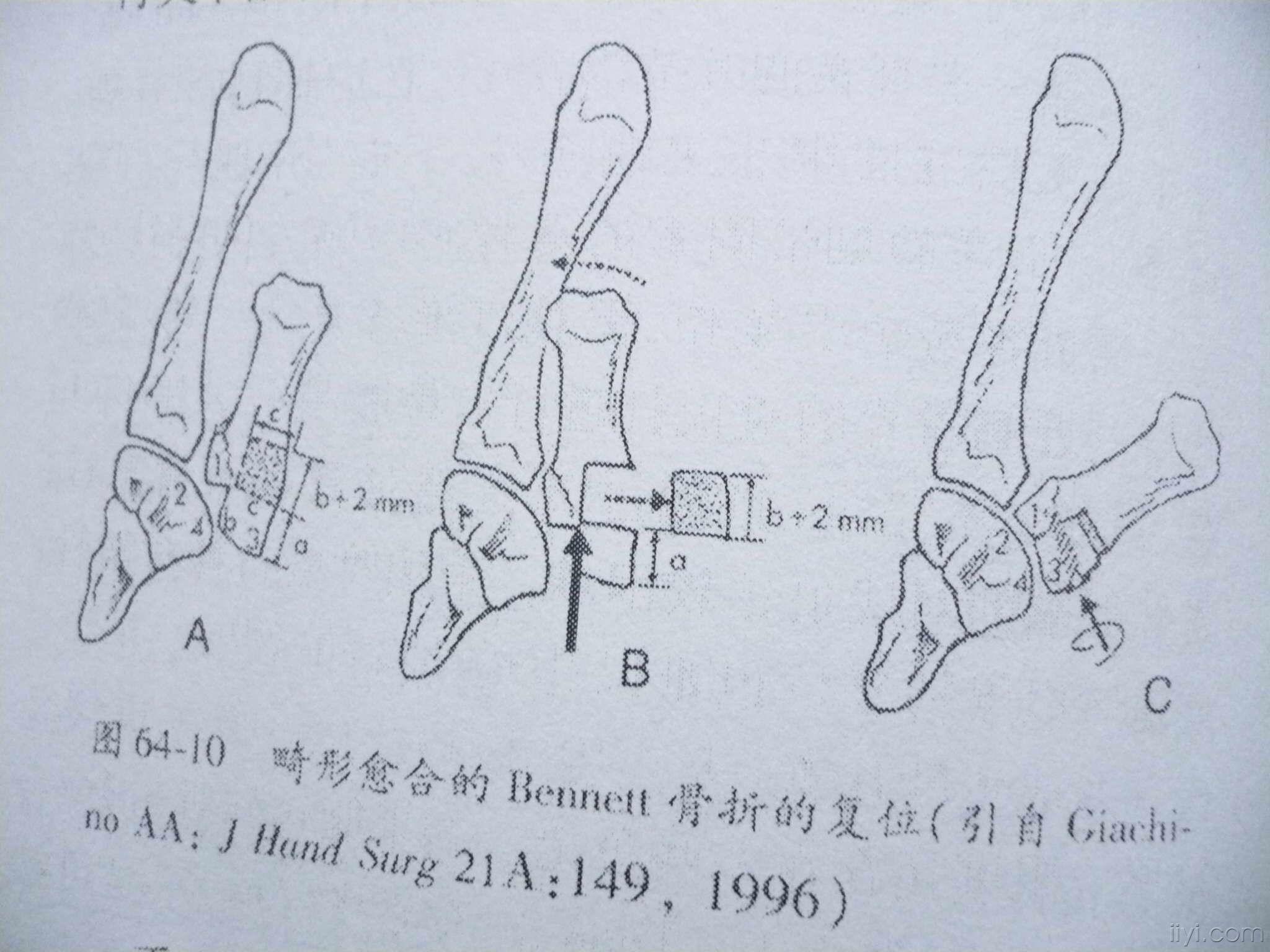 陈旧性bennett骨折